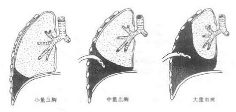 三胸二塞一氣傷|創傷性血胸